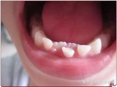 32颗牙齿人的命运,长了32颗牙齿的命运