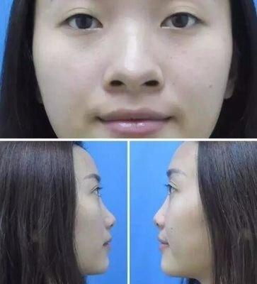 “塌鼻子”面相的人命运怎样 塌鼻子面相最全分析