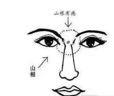 为什么山根有痣就不好了 山根有痣是什么意思