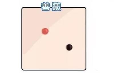 什么样的痣是好痣 好痣一般长在哪里