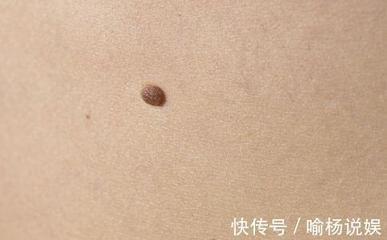什么样的痣是好痣 好痣一般长在哪里