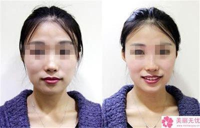 分析鼻子明显不正鼻梁歪斜的人是凶相吗