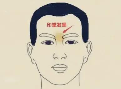 印堂凹陷是怎么回事 印堂凹陷解读命运