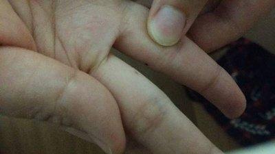 右手无名指突然长痣有什么含义你知吗