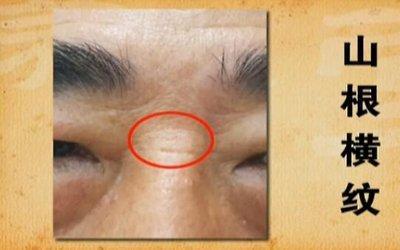 女生鼻梁上有横纹好吗 是在预示着什么