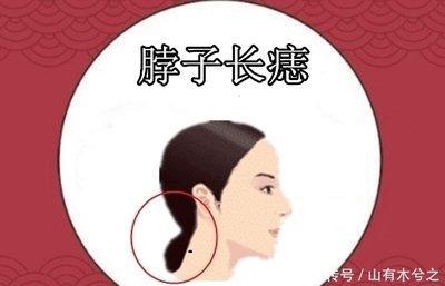女人脖子上长痣代表什么 脖子长痣的女人运势如何