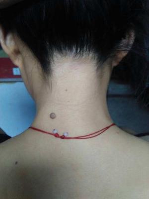 女人脖子上长痣面相图，男人脖子上长痣面相图