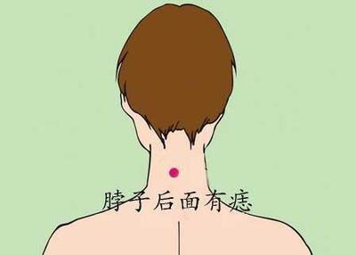 女人脖子后面有痣代表什么意思 女人脖子有痣代表什么