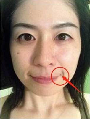 女人面部痣图解大全 脸上长痣的女人命运好吗