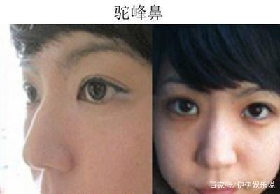 嫁给驼峰鼻的男人会幸福终身么 驼峰鼻男人可以嫁吗