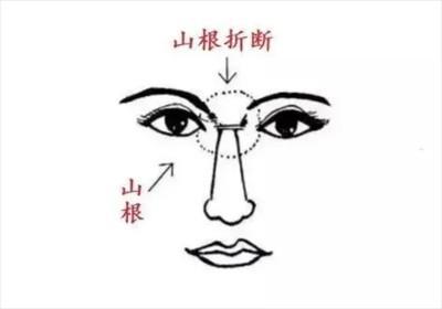 山根折断有什么后果 山根折断真的是不好吗