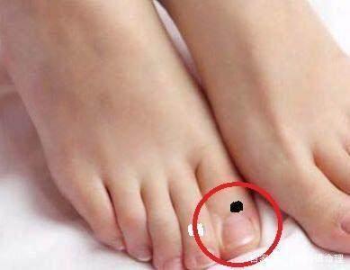 左手无名指长痣代表了什么 左手无名指长痣好不好