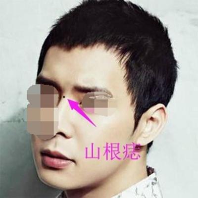 所有山根有痣的男人都不好吗 命好不好呢