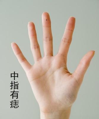 手上长痣图解 手上有痣你知道好不好吗