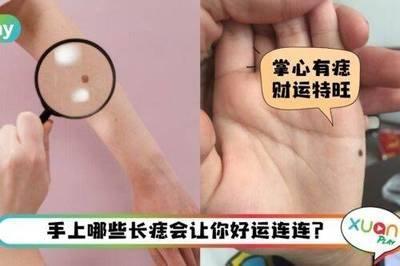 手上长痣长在什么地方对财运最好 手中哪里长痣财运好