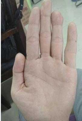 手上青筋看出你的健康状况 手上青筋与健康运势的关系