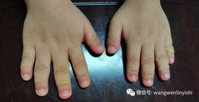 手指短又粗代表什么 手指粗短的人命运好吗