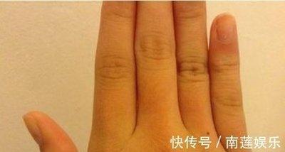 手指长痣的命运 手指长痣代表着什么