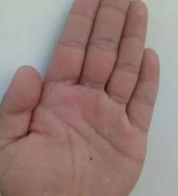 手掌金星丘有痣是凶还是吉知道多少