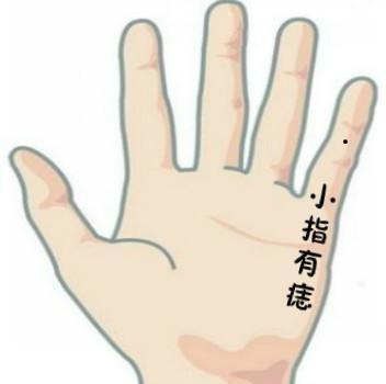 手痣相图解分析 你知道手指长痣是什么意思吗