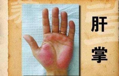手背青筋突起是不是命不好 手背青筋突起说明什么
