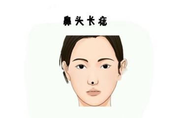 最有福气的3处吉痣 哪里长痣有福气