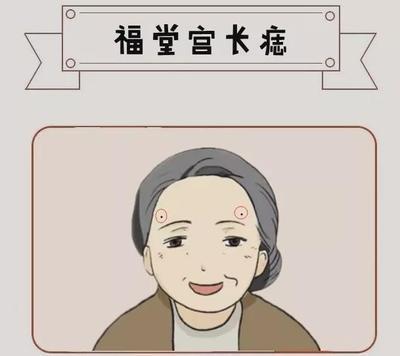 最有福气的3处吉痣你有吗 哪几个地方长痣是有福气