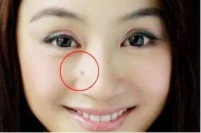 最有福气的三处痣一看就知道 什么地方有痣代表有福气
