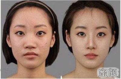 歪鼻子的人命运如何 歪鼻子代表着什么