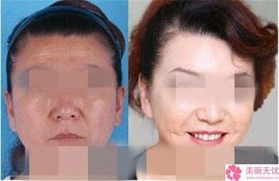 法令纹左右不对称意味着什么 法令纹左右不对称好不好