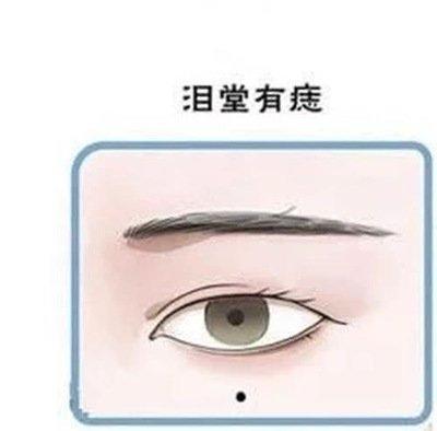 泪堂有痣代表哪些预示 泪堂有痣哪里不好