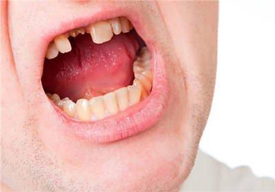 正确分析梦见牙齿掉了的含义特点 了解牙齿的象征