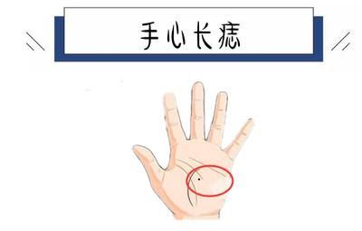 男女手掌心都有痣代表什么意思 手掌心长痣好吗
