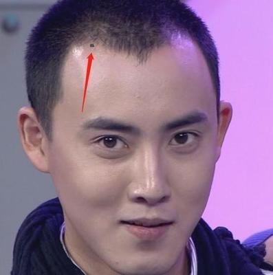 男人发际线有痣代表着什么 如何看男人发际线上的痣
