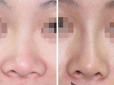男人蒜头鼻面相如何 男人长有蒜头鼻是怎样的命运