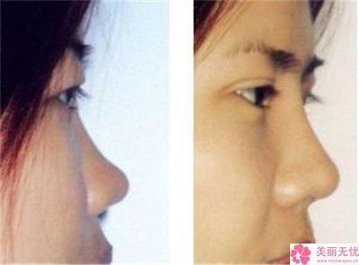 男人鼻翼宽代表什么  鼻翼宽的男人命运好吗