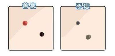 痣也有好和不好 女人哪里有痣犯桃花的
