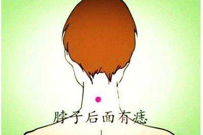 痣在脖子位置与命运图解 脖子上长痣是什么意思