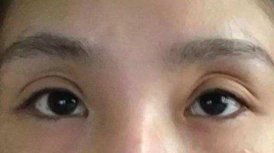 眼窝凹陷的人是不是运气很差 眼窝凹陷是什么意思