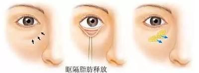 眼窝凹陷的人是不是运气很差 眼窝凹陷是什么意思