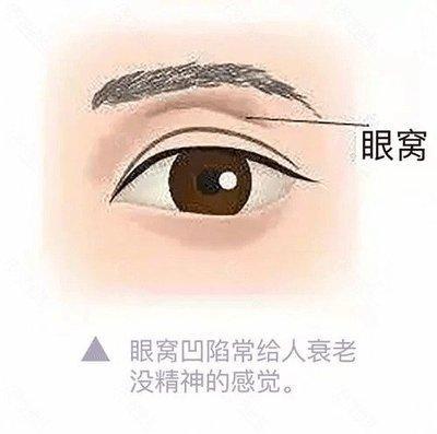 眼窝凹陷面相分析 眼窝凹陷的人是不是运气很差