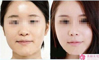 眼窝凹陷面相好吗 眼窝凹陷面相分析