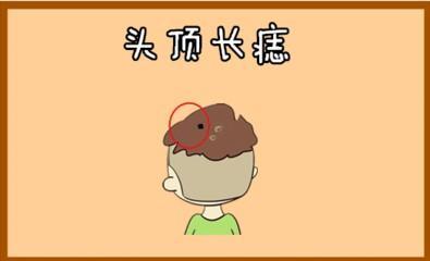 真正富贵之极四处痣 哪几个地方长痣的人有钱