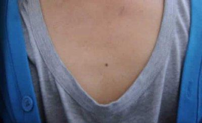 胸前有痣的人代表着什么 胸前有痣的人命运如何