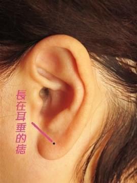 耳朵长痣看吉凶 教你看耳朵长痣的好与坏