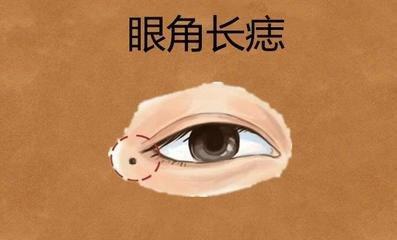脸上哪些地方有痣的女人天生苦命 命不好的女人痣相