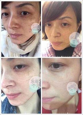 脸上哪些痣会破坏你的工作事业运难成功