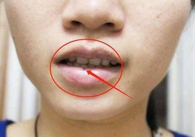 脸上痣的位置与命运解析 脸上长痣说明了什么