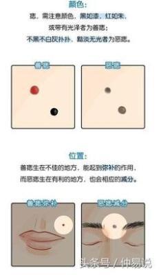 脸上长痣不同部位代表着什么 脸上长痣到底好不好