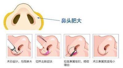 蒜头鼻的人财运好不好 蒜头鼻的人运势分析